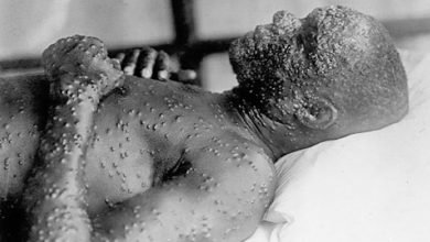 Photo of OMS declara emergencia internacional por el brote de viruela del mono