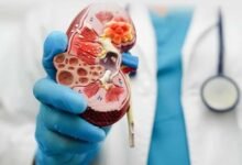 Photo of Enfermedad renal crónica: novena causa de muerte en el mundo